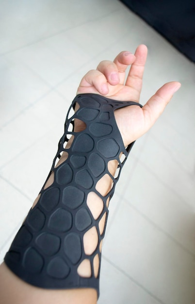 Black orthopedic plastic prosthesis printed on powder d printer on hand