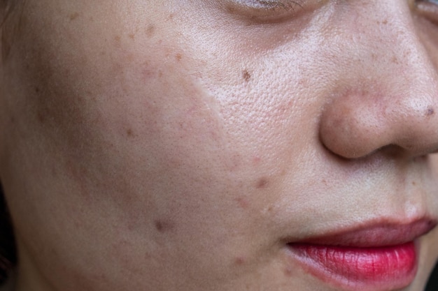 Photo black spots scars and acne on the face of asian young woman