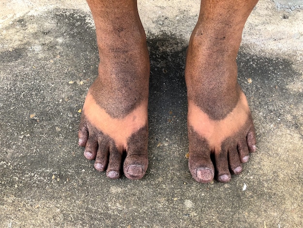 Photo black spray on the feet.