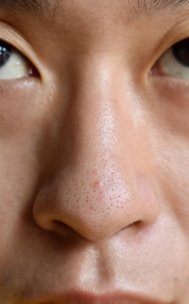 Blackheads or black heads on nose of Asian man