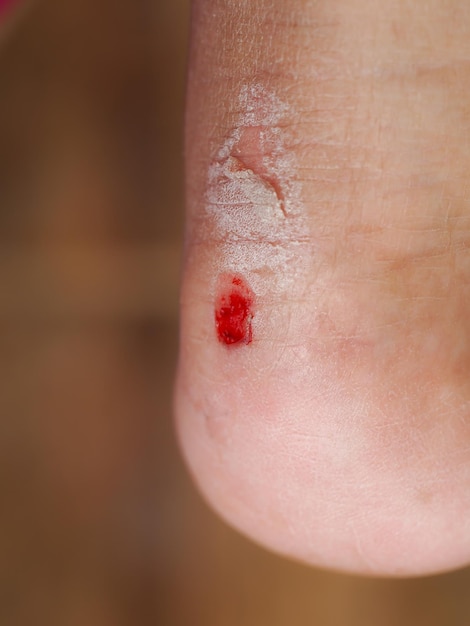 Bleeding wound on the heel caused by an accident.