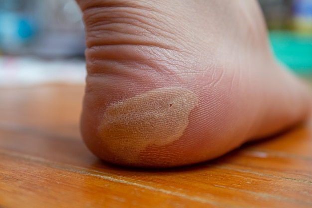 Blister on the foot. Foot health concept. Health problems.