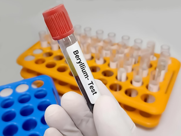 Bloedmonster voor beryllium zware metalen test toxisch metaal Diagnose van beryllium toxiciteit