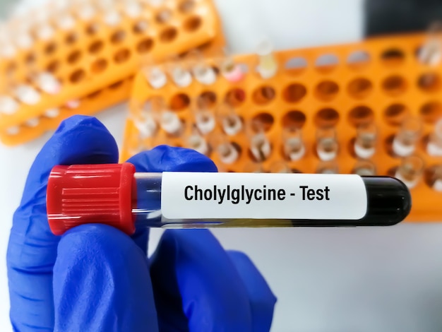 Bloedmonster voor cholylglycine- of glycocholzuurtest in laboratorium