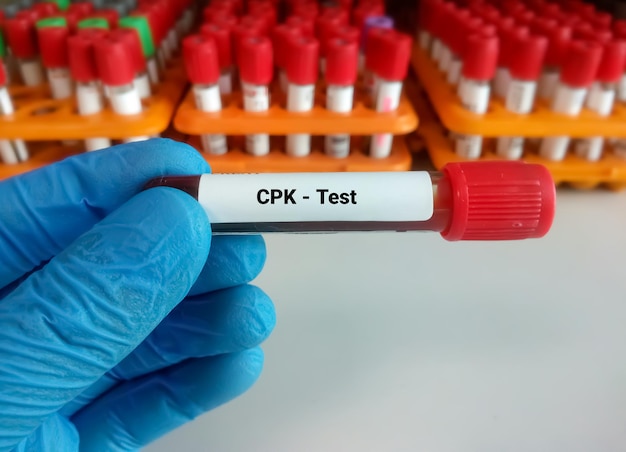 Foto bloedmonster voor creatinefosfokinase- of cpk-enzymtest