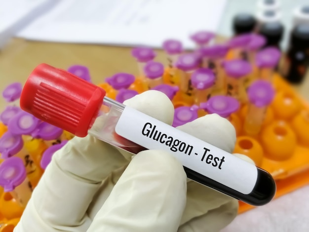 Bloedmonster voor Glucagon-test. Pancreatitis.