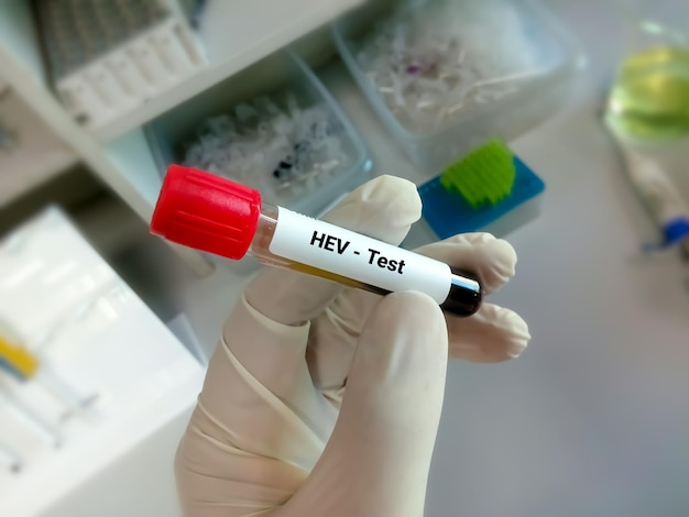 Bloedmonster voor HEV- of hepatitis E-virustest