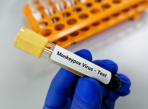 Bloedmonster voor Monkeypox-virus test een DNA-virus en lid van de pokkenviridae-familie