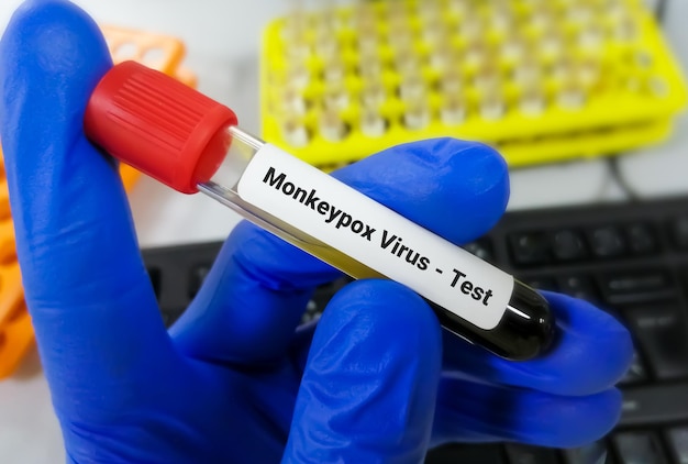 Bloedmonster voor Monkeypox-virustest