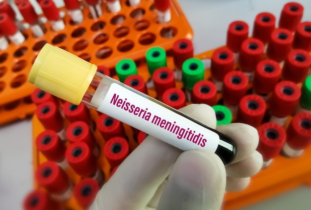 Bloedmonster voor Neisseria meningitidis-test, om meningokokkenziekte te diagnosticeren. SOA's