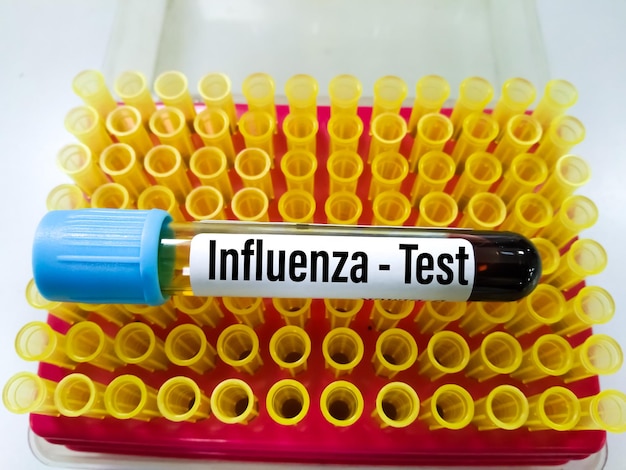 bloedmonsters voor Influenza A-, B-virus en subtype H1N1-, H1N2- en H1N3-test in medisch laboratorium