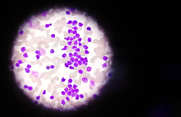 Bloeduitstrijkje onder microscopie met chronische lymfoblastische leukemie (CLL)