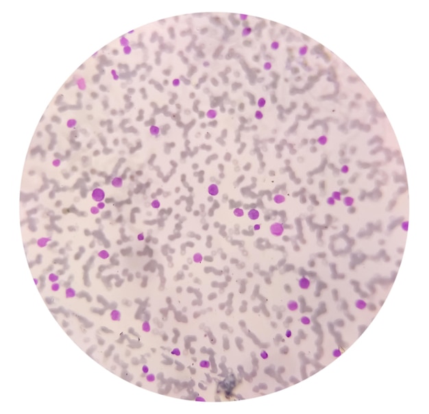 Bloedziekte leukocytose en leukopenie geanalyseerd door lichtmicroscoop