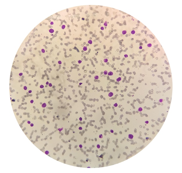 Bloedziekte leukocytose en leukopenie geanalyseerd door lichtmicroscoop