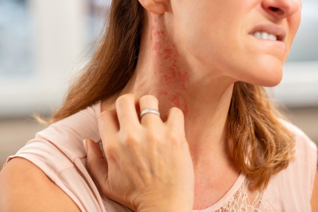 Blond woman wearing ring on finger having rash on neck because of allergy