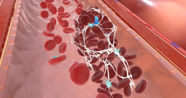 A blood clot is red blood cells that stick together in the bloodstream and are held in place by fibrin