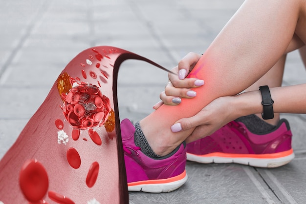 Foto coaguli di sangue nella malattia delle gambe