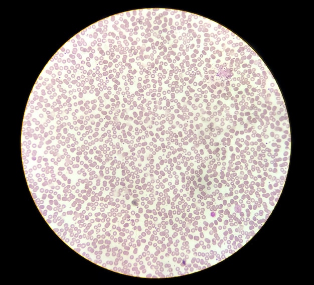 Photo blood disease leucocytosis and leukopenia analysed by light microscope