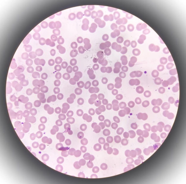 Il film di sangue al microscopio mostra una diminuzione delle piastrine e dei leucociti (wbc). porpora trombocitopenica (itp)