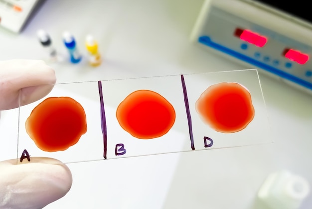 Blood group and rh factor testing by slide agglutination method\
showing o negative blood group