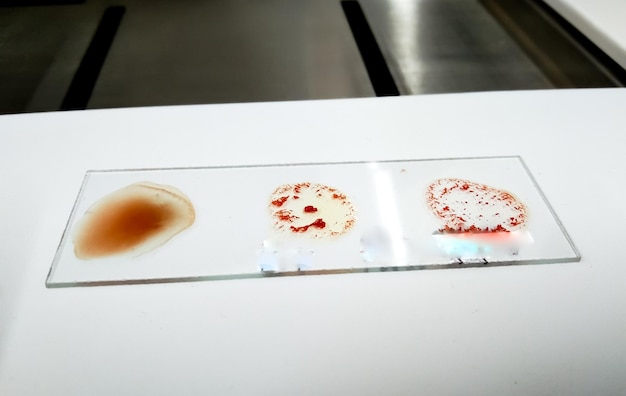 Blood group testing by slide agglutination method at medical laboratory.