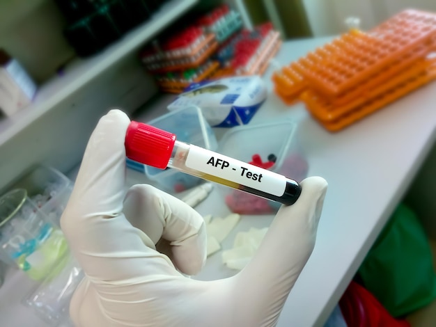 Blood sample for AFP Alpha fetoprotein testing a tumor or cancer marker for liver