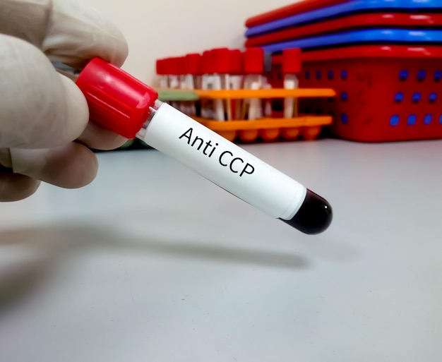 Blood sample for Anti CCP test diagnosis of rheumatoid arthritis disease