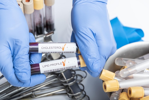 Photo blood sample for cholesterol testing