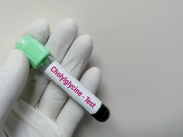 Blood sample for cholylglycine or Glycocholic acid test in laboratory