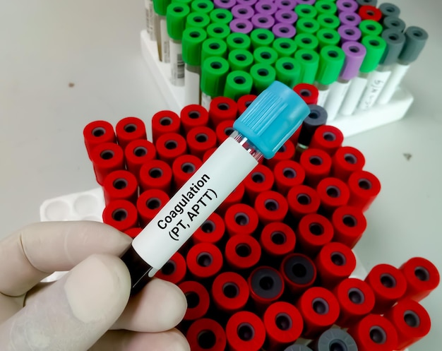 Photo blood sample for coagulation pt and aptt testing