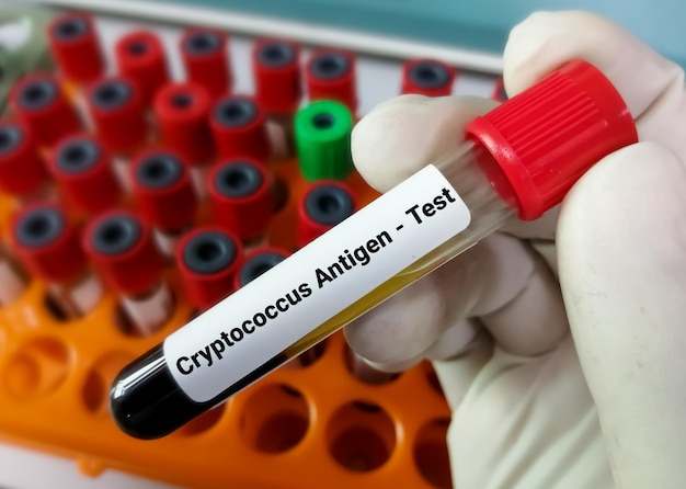 Blood sample for Cryptococcus Antigen test.