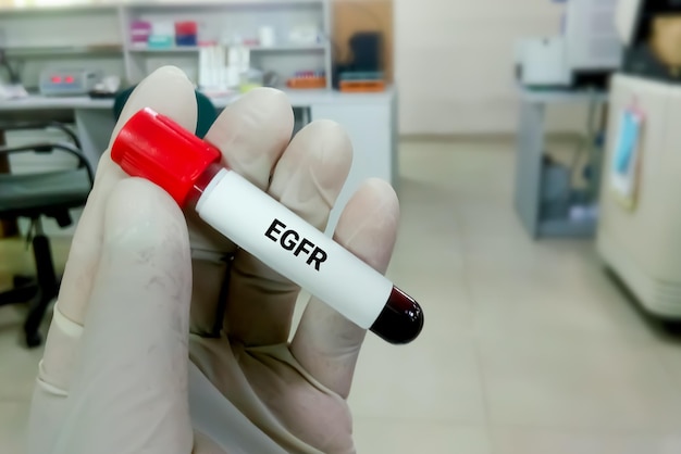 Foto campione di sangue per egfr o test della velocità di filtrazione glomerulare stimata