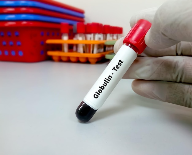 Blood sample for globulin test for the diagnosis of liver\
disease