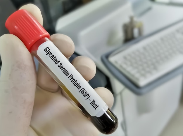 Campione di sangue per il test della proteina sierica glicata (gsp), concetto di test per diabetici.