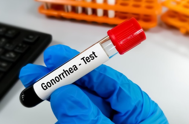 Photo blood sample for gonorrhea test syphilis gonorrhea disease