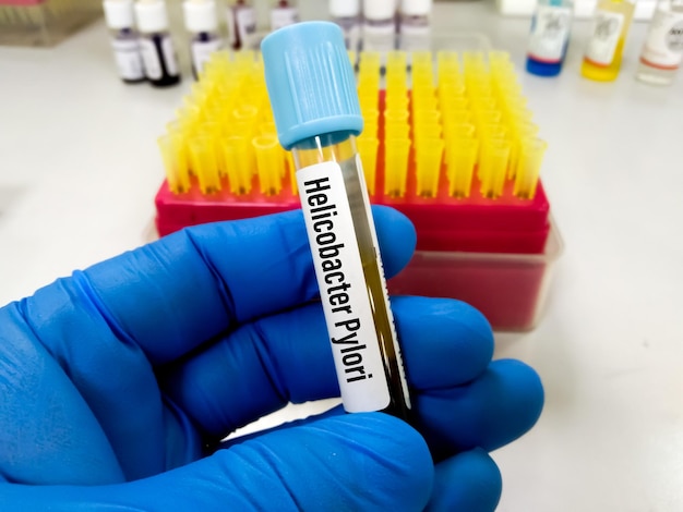 Photo blood sample for h. pylori (iga, igg and igm) test, helicobacter pylori test, to diagnose uti