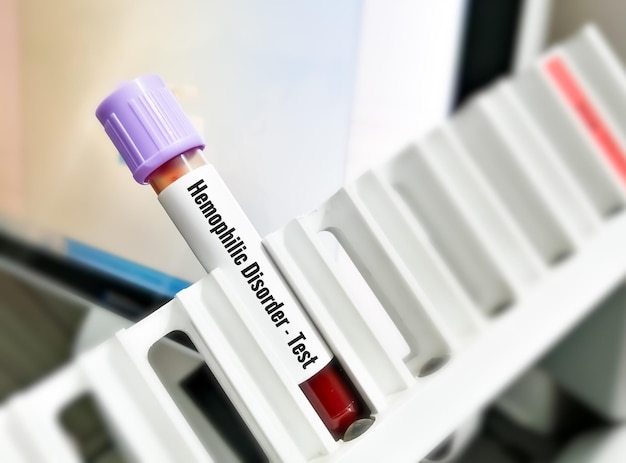 Photo blood sample for hemophilia test, inherited genetic disorder