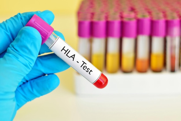 Photo blood sample for hla human leukocyte antigen test