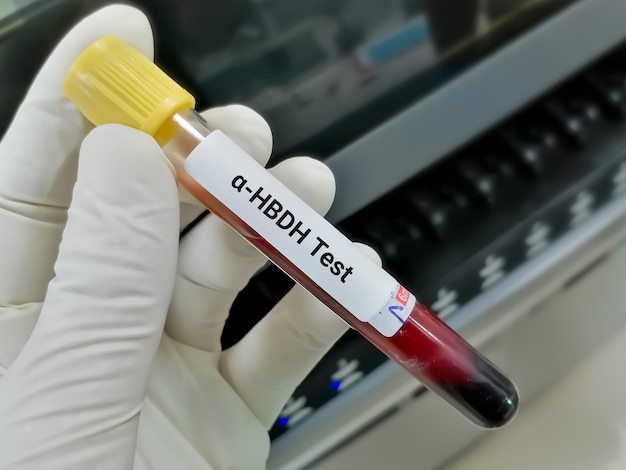 Blood sample for a Hydroxybutyrate dehydrogenase or aHBDH test diagnosis of myocardial infraction