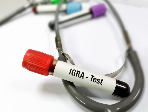 Photo blood sample for igra(interferon gamma release assay) test for diagnosis of tuberculosis