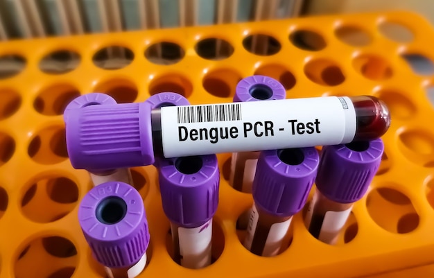 Blood sample isolated for Dengue Virus PCR test. Dengue viral load.