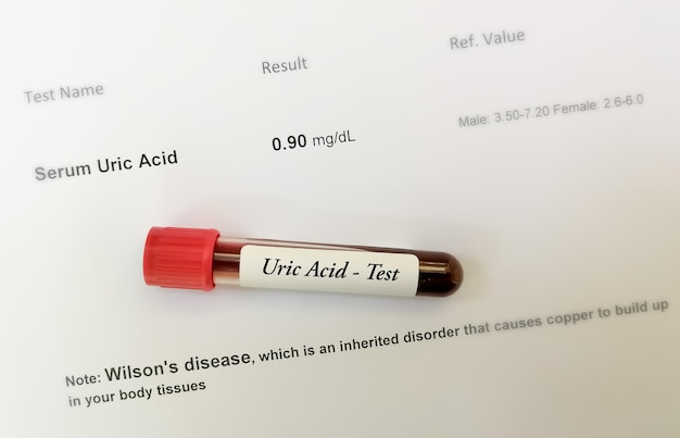 Blood sample isolated with abnormal low uric acid test result which can cause Wilson's disease