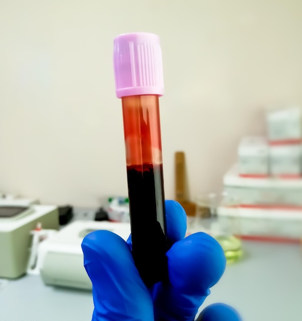 Blood sample in lavender tube for biochemical analysis or Hematological analysis or PCR testing