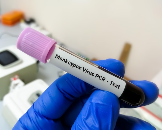 Foto il campione di sangue per il virus monkeypox pcr testa un virus del dna e un membro della famiglia poxviridae