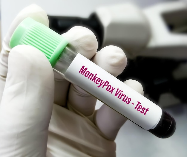 Blood sample for Monkeypox virus test