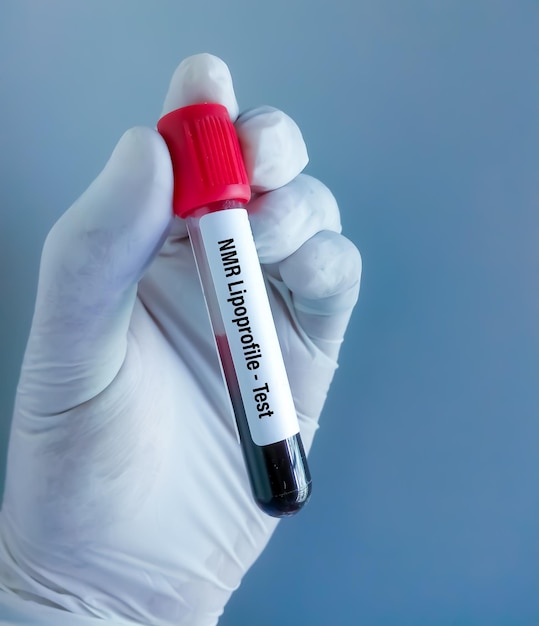 Blood sample for NMR Lipoprofile test.