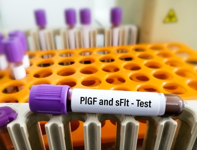 태반 성장 인자 또는 PIGF 및 가용성 fmslike tyrosine kinase 또는 sFLT 검사를 위한 혈액 샘플