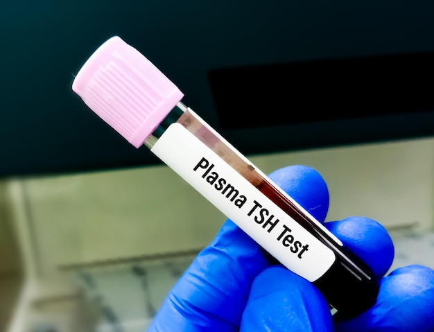 Blood sample for plasma TSH test for thyroid disease diagnosis