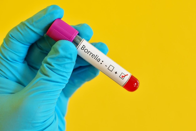 Blood sample positive with borrelia test lyme disease diagnosis