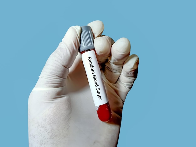 Blood sample for Random Blood Sugar RBS test A medical testing concept with various test tubes